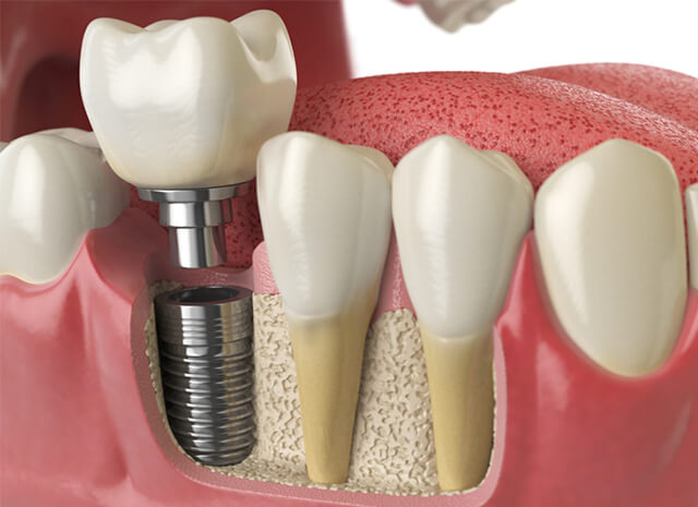 The Importance of Choosing the Right Dental Implants in London