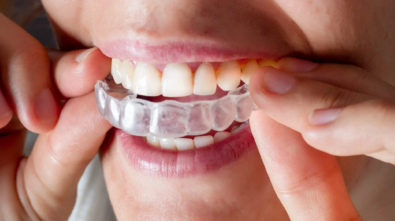 Invisalign: Redefining Teen Orthodontics with Clear Aligners